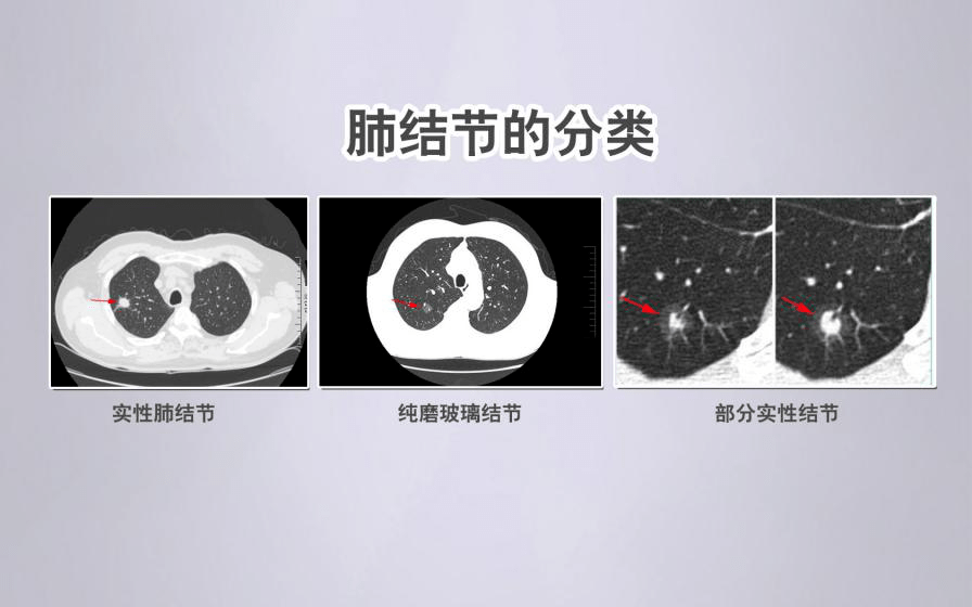 “阳康”后，体检查出肺结节？别急！