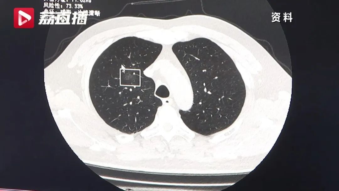 “阳康”后，体检查出肺结节？别急！